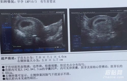 香港验血男症状女(6周香港验血男女准吗,需要什么条件) 