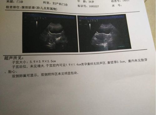 胎芽没到10mm香港验血准嘛(香港验血胎芽一定要10mm吗,如果满7